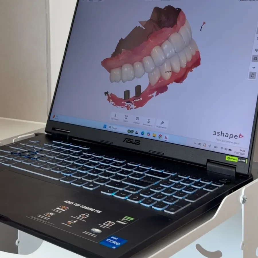 Цифрова 3D-модель зубів на екрані ноутбука після інтраорального сканування